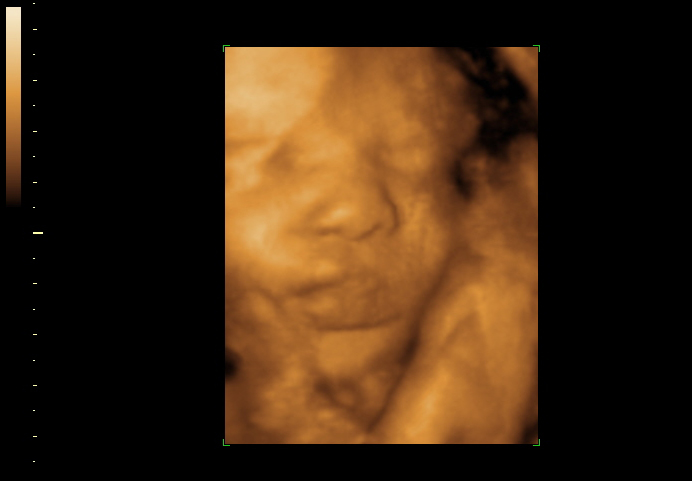 3D ultrasound image at 34 weeks
